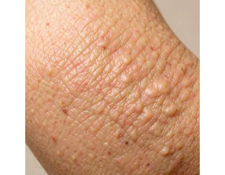cellulite